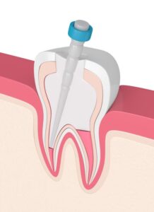 Root canal winnipeg